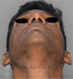 Rhinoplasty (Nose Corrections)