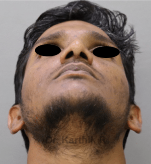 Rhinoplasty (Nose Corrections)