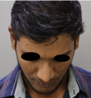 Rhinoplasty (Nose Corrections)