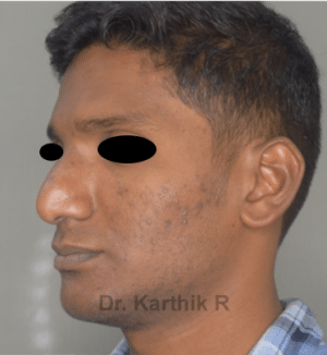 Rhinoplasty (Nose Corrections)