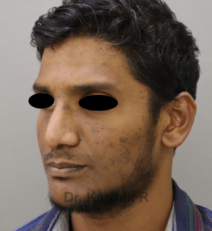 Rhinoplasty (Nose Corrections)