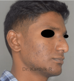 Rhinoplasty (Nose Corrections)