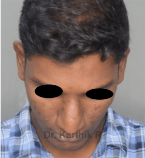 Rhinoplasty (Nose Corrections)