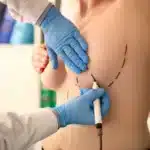 Plastic Surgeon Preparing For Breast Reduction Surgery