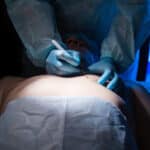 Gynecomastia Surgery