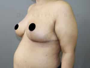 Breast Reduction and Breast Lift