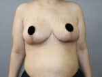 Breast Reduction and Breast Lift