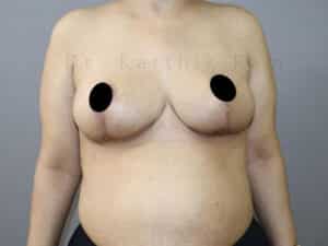 Breast Reduction and Breast Lift