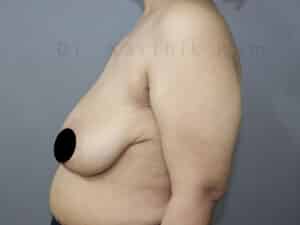 Breast Reduction and Breast Lift