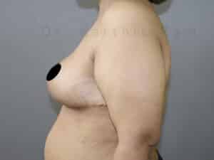 Breast Reduction and Breast Lift