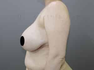 Breast Reduction and Breast Lift