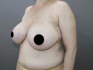 Breast Reduction and Breast Lift