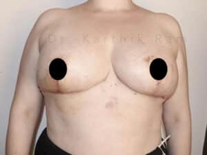 Breast Reduction and Breast Lift