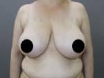 Breast Reduction and Breast Lift