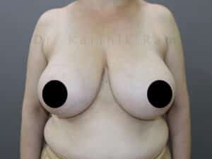 Breast Reduction and Breast Lift