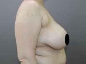Breast Reduction and Breast Lift