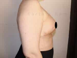 Breast Reduction and Breast Lift
