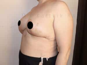 Breast Reduction and Breast Lift