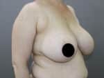 Breast Reduction and Breast Lift
