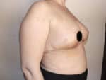 Breast Reduction and Breast Lift