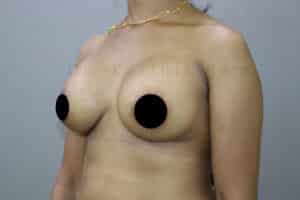 Breast Implants (Breast Augmentation)