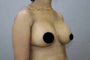 Breast Implants (Breast Augmentation)