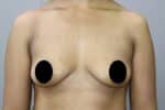 Breast Implants (Breast Augmentation)