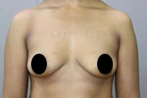Breast Implants (Breast Augmentation)