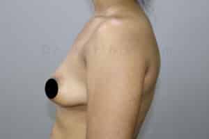 Breast Implants (Breast Augmentation)