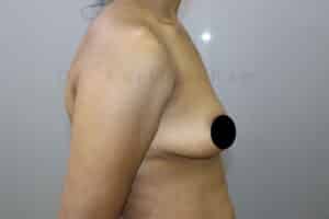 Breast Implants (Breast Augmentation)