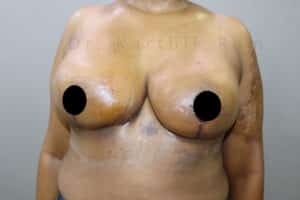 Breast Reduction and Breast Lift