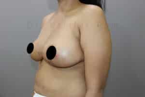 Breast Reduction and Breast Lift