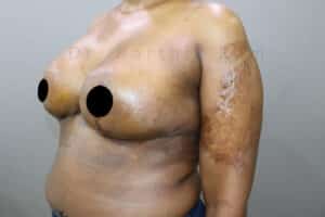 Breast Reduction and Breast Lift