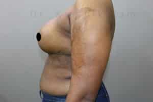 Breast Reduction and Breast Lift