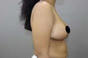Breast Reduction and Breast Lift