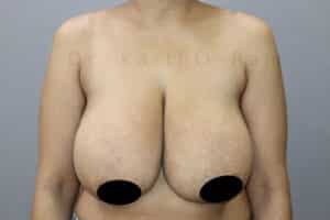 Breast Reduction and Breast Lift