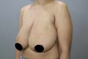 Breast Reduction and Breast Lift