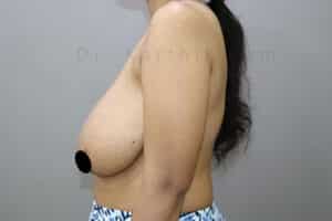 Breast Reduction and Breast Lift