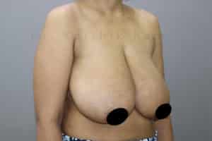 Breast Reduction and Breast Lift