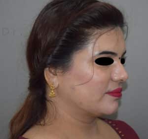 Double Chin Liposuction