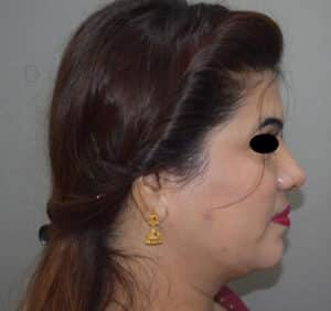 Double Chin Liposuction