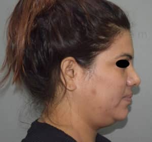 Double Chin Liposuction