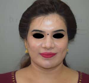 Double Chin Liposuction