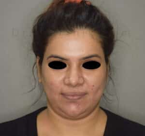 Double Chin Liposuction