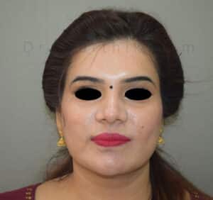 Double Chin Liposuction