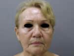 Blepharoplasty
