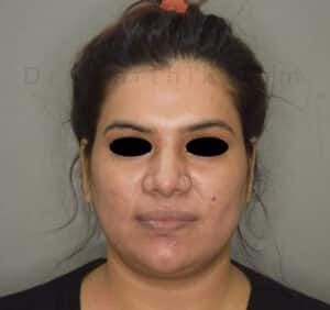 Double Chin Liposuction