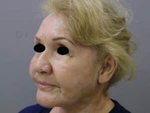 Blepharoplasty