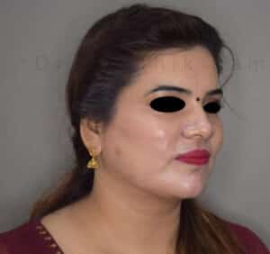 Double Chin Liposuction