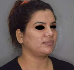 Double Chin Liposuction